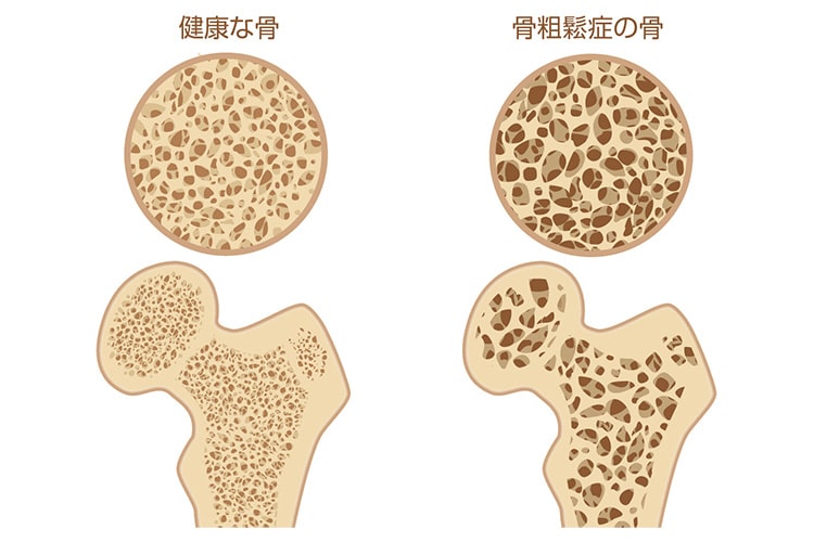 骨粗鬆症画像